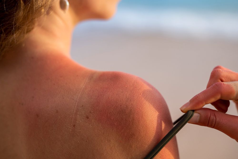Procedimentos estéticos no verão exigem mais cuidado, alerta especialista