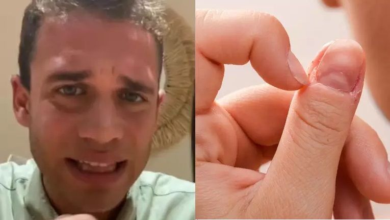 Influenciador sofre AVC após infecção causada por hábito de roer unhas