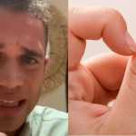Influenciador sofre AVC após infecção causada por hábito de roer unhas