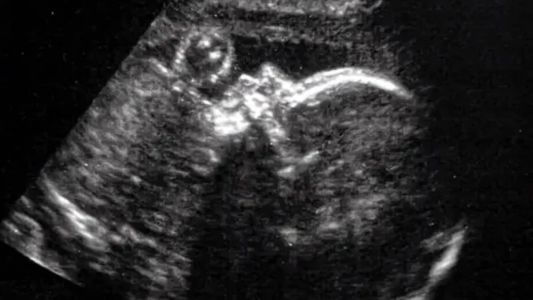 A cirurgia, realizada com 34 semanas e 2 dias de idade gestacional