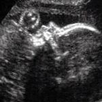 Bebê com doença genética rara é operado dentro do útero da mãe e sobrevive; entenda  