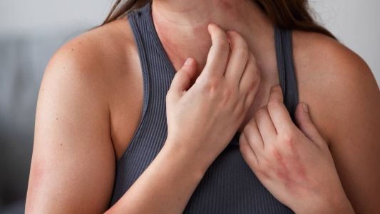 A dermatite atópica é uma doença crônica e hereditária que causa uma inflamação na pele