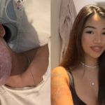 Influenciadora contrai doença após emprestar pincéis de maquiagem e fica com o rosto 'detonado'