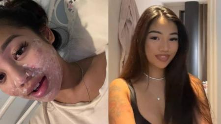A jovem de 22 anos, Louaira Dela Cruz, contraiu uma micose após compartilhar pincéis de maquiagem com as amigas