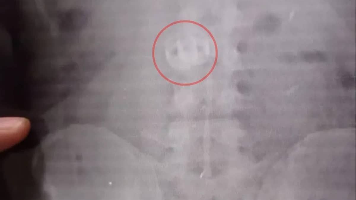Ladrão engole alianças roubadas de turistas para enganar a polícia, mas raio x mostra joias