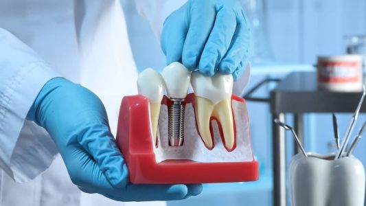 O primeiro passo é marcar uma consulta com um dentista que seja especialista ou que tenha experiência em implantes dentários