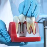 Implantes Dentários: o que é importante saber antes de fazer