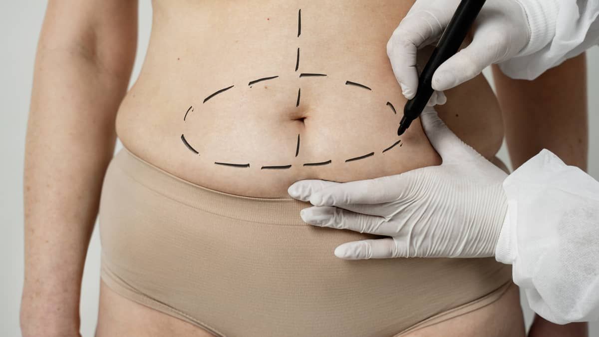 Luciana Pepino | Barriga pós‑gestação: quando a cirurgia resolve de verdade?
