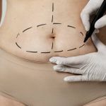 Luciana Pepino | Barriga pós‑gestação: quando a cirurgia resolve de verdade?