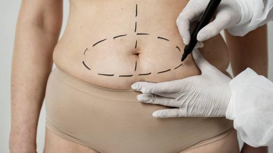 Abdominoplastia