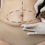 Abdominoplastia: tudo o que você precisa saber