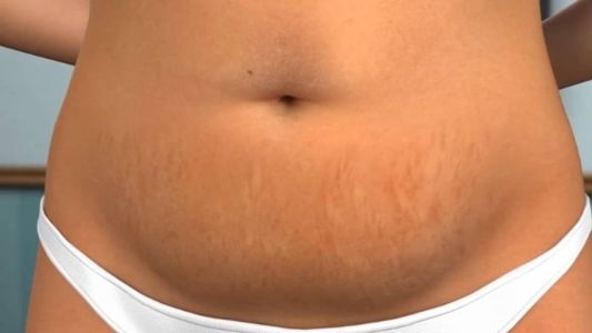 Abdominoplastia é uma cirurgia plástica realizada para retirar o excesso de pele e gordura localizada