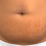 Veja os riscos da abdominoplastia, cirurgia feita por mulher que morreu em clínica de BH