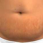 Veja os riscos da abdominoplastia, cirurgia feita por mulher que morreu em clínica de BH