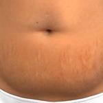 Veja os riscos da abdominoplastia, cirurgia feita por mulher que morreu em clínica de BH