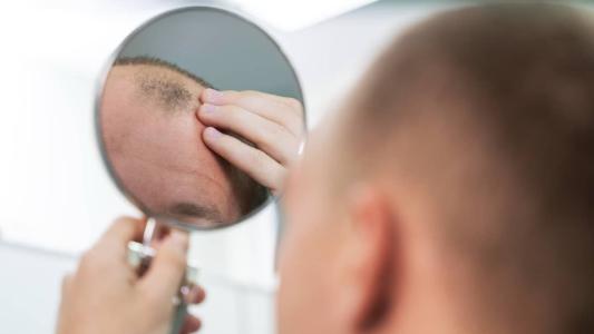 Além da calvície homens que tomam refrigerante diariamente também tem maiores chances de desenvolver depressão e ansiedade