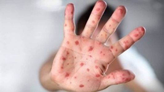 Além das manchas avermelhadas, a Síndrome Mão-Pé-Boca causa febre e prostação