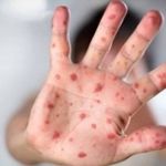 Catapora ou síndrome-mão-pé-boca? Entenda diferença, sintomas, causas e tratamento