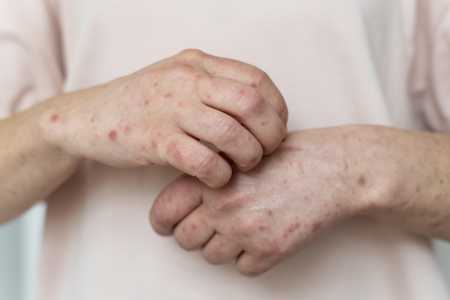 Pessoa com alergia e manchas vermelhas na pele