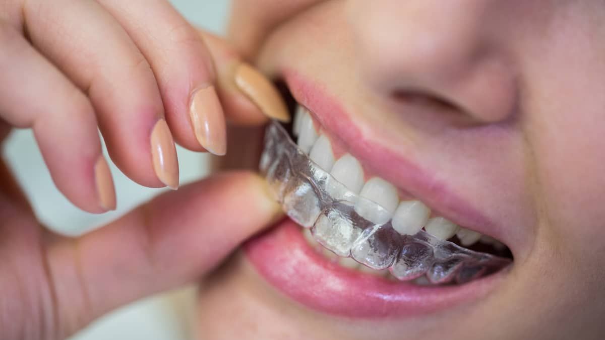 Sorriso em harmonia: saiba como os alinhadores ortodônticos podem transformar sua autoestima 