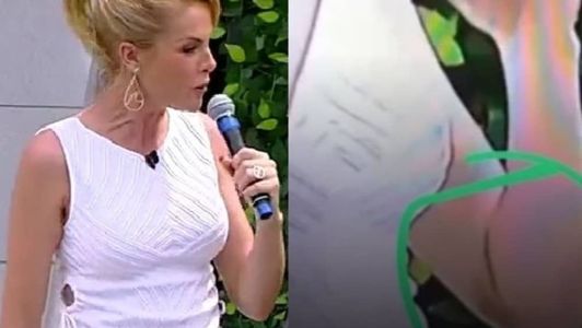 Ana Hickmann exibe suposto hematoma
