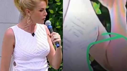 Ana Hickmann exibe suposto hematoma