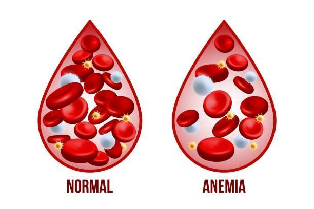 Fabiana de Lemos | Anemia pode esconder câncer de intestino