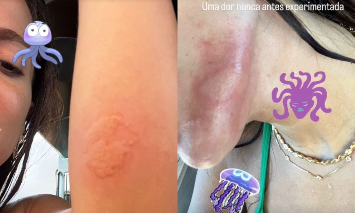 Anitta tem reação inusitada após tomar choque de água-viva: 'Dor do fim da vida'
