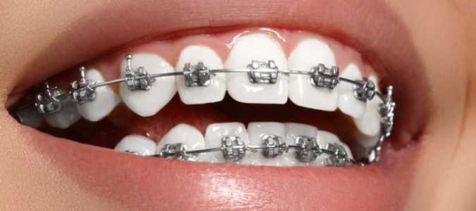 Aparelho dentário precisa ser feito com materiais autorizados