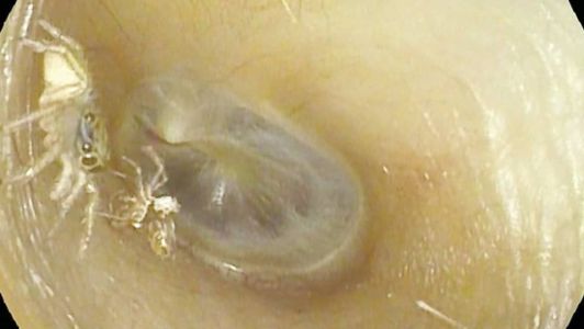 Aranha estava dentro do ouvido da paciente