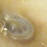 Vídeo: aranha 'invade' ouvido de mulher que procura ajuda depois de 4 dias ouvindo 'sons anormais'