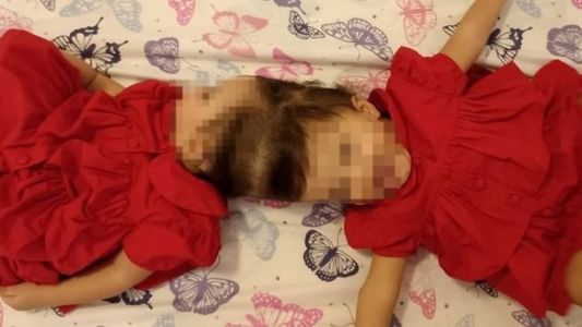 As irmãs foram submetidas à quatro cirurgias para serem completamente separadas