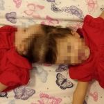 Gêmeas siamesas unidas pela cabeça são separadas após 25 horas de cirurgia em SP