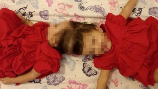 As irmãs foram submetidas à quatro cirurgias para serem completamente separadas