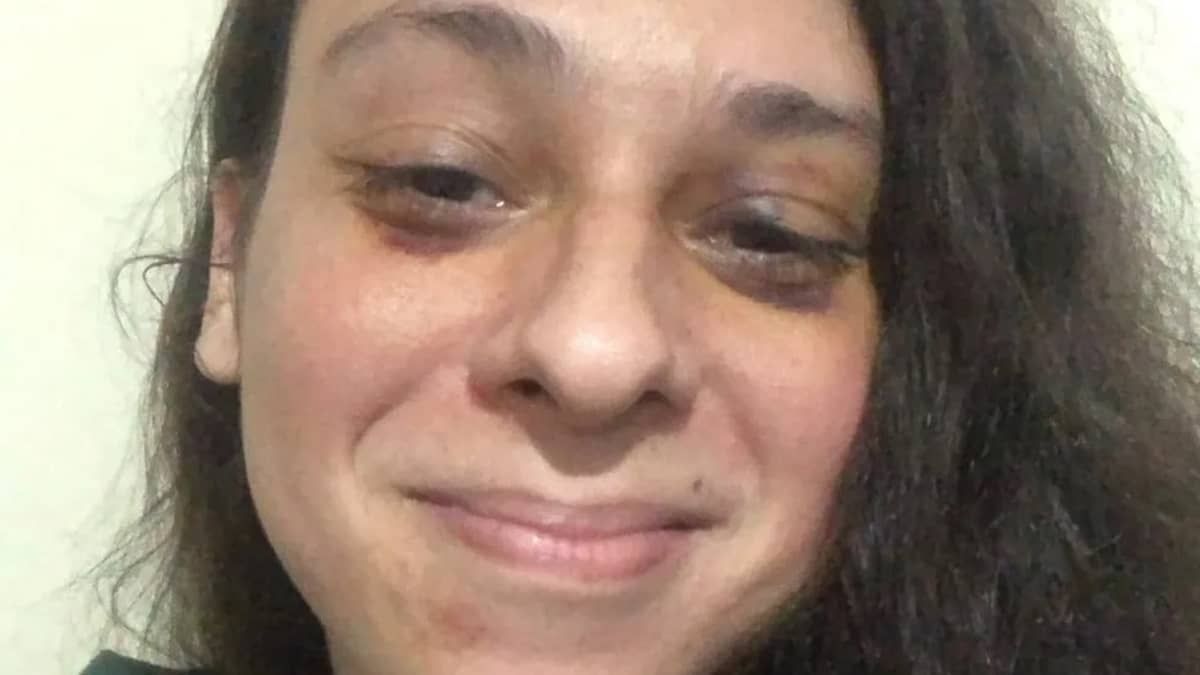 Ator Victor Meyniel posta foto do rosto seis dias depois de ser espancado  
