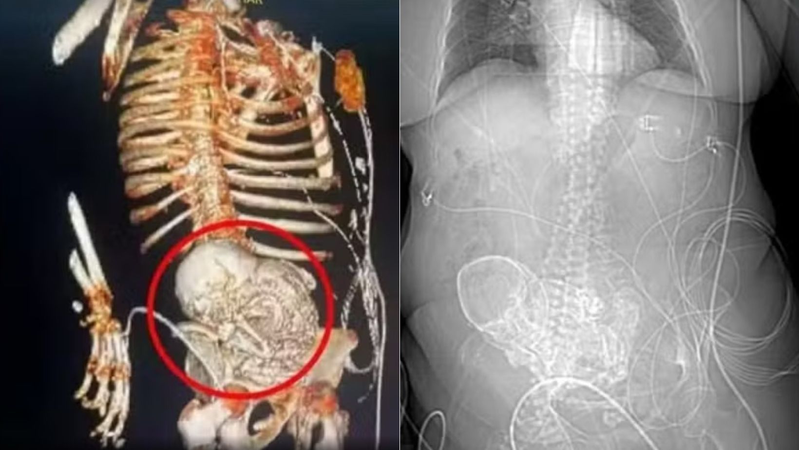 Vídeo: cientistas vão estudar bebê calcificado que ficou mais 50 anos em barriga de idosa