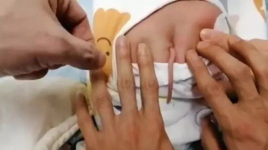 Foto mostra bebê que nasceu com cauda na China