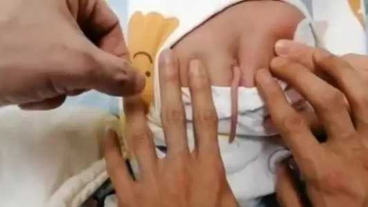 Foto mostra bebê que nasceu com cauda na China