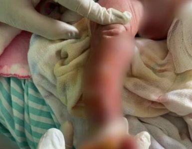 Bebê teve pernas queimadas durante banho em maternidade do Acre
