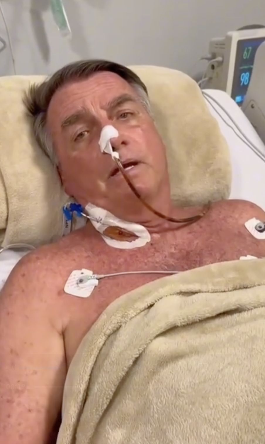 Bolsonaro internado: cirurgia demora mais que o esperado e deve acabar até às 20h