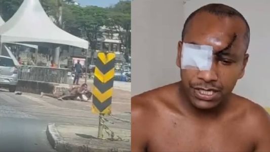 Bruno Adão perdeu o olho direito após ser baleado por policial militar
