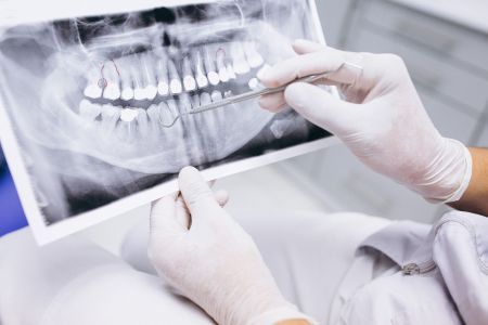 Bruxismo pode causar perda óssea nas raízes dos dentes