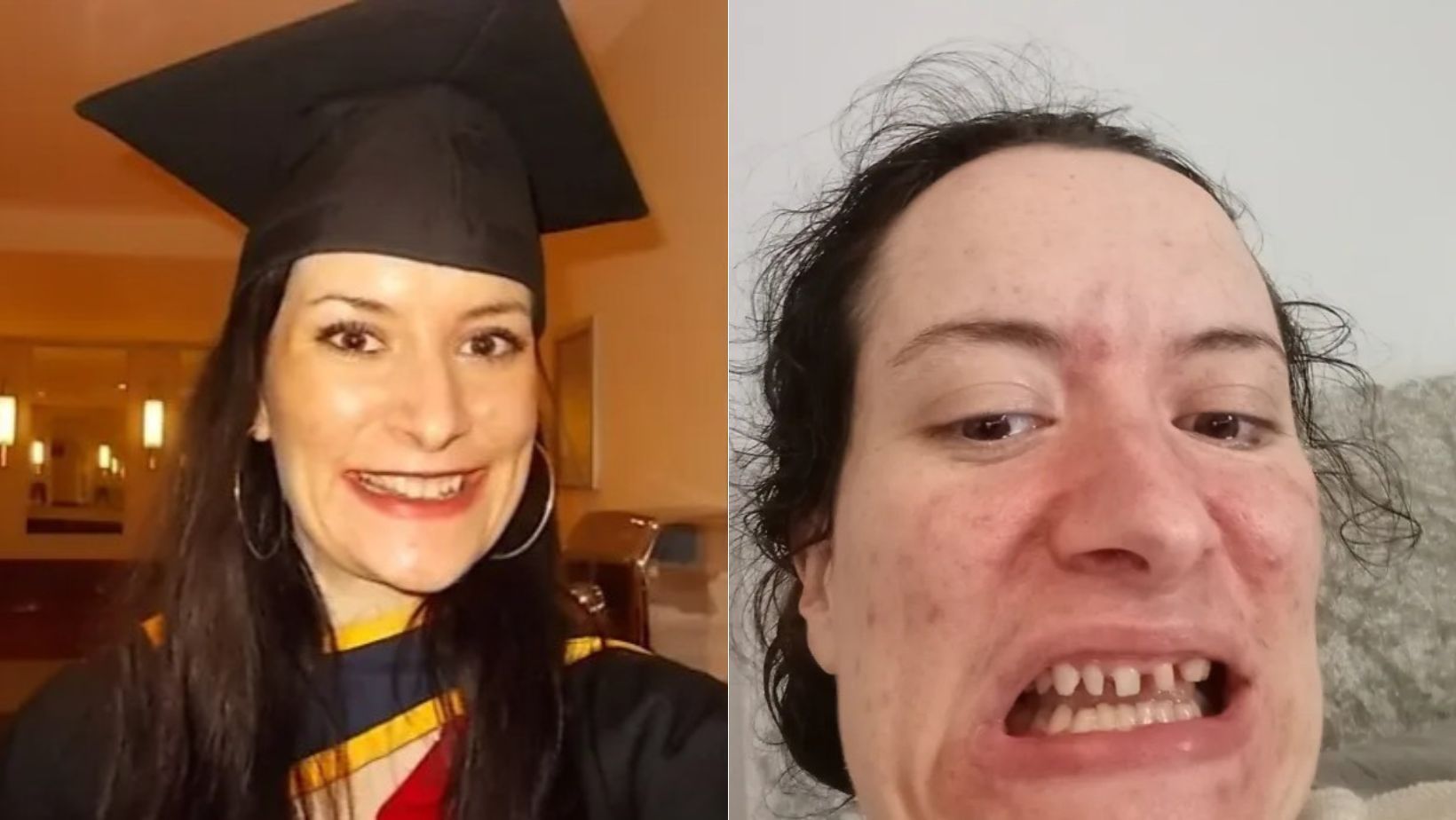 Mulher sofre de bruxismo e diz que dentes estão desaparecendo: 'Acabo cuspindo nas pessoas'