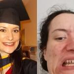Mulher sofre de bruxismo e diz que dentes estão desaparecendo: 'Acabo cuspindo nas pessoas'