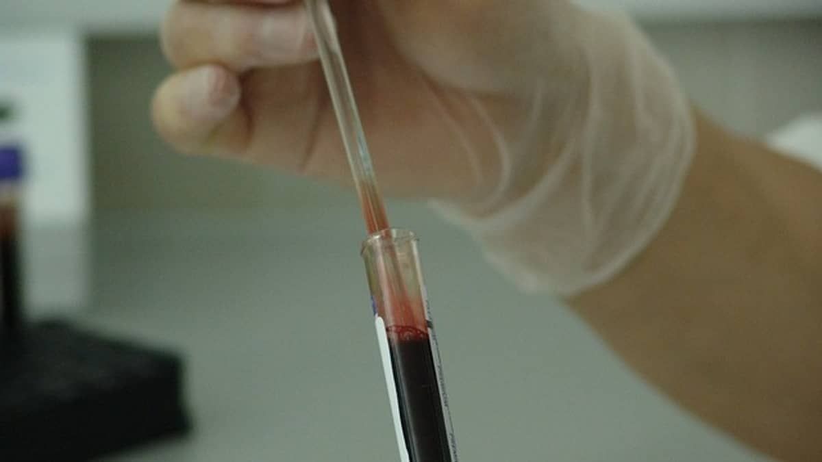 Estudo aponta novo diagnóstico para câncer na tireoide