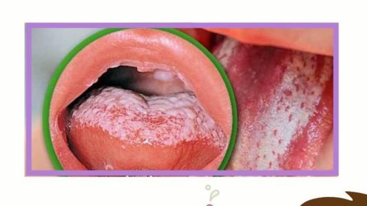 Candidíase e nutrição é tema da série Nutriação