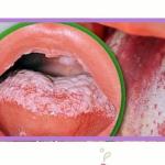 Candidíase e nutrição é tema da série Nutriação