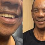 Cantor de BH que perdeu todos os dentes em acidente ganha implante: ‘mudou minha vida’