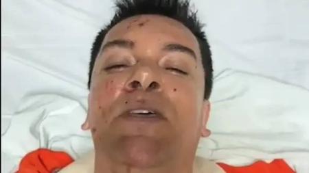 Cantor passou por cirurgia de emergência após ter o intestino delgado perfurado durante acidente