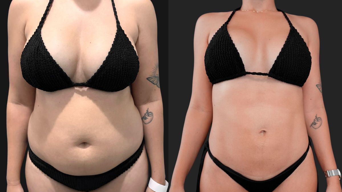 Médico mineiro cria abdominoplastia sem cicatriz visível e com menos tempo de recuperação